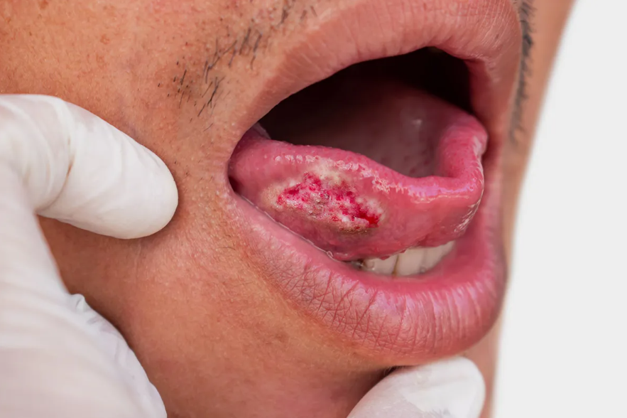 ¿Qué es el cáncer de boca?